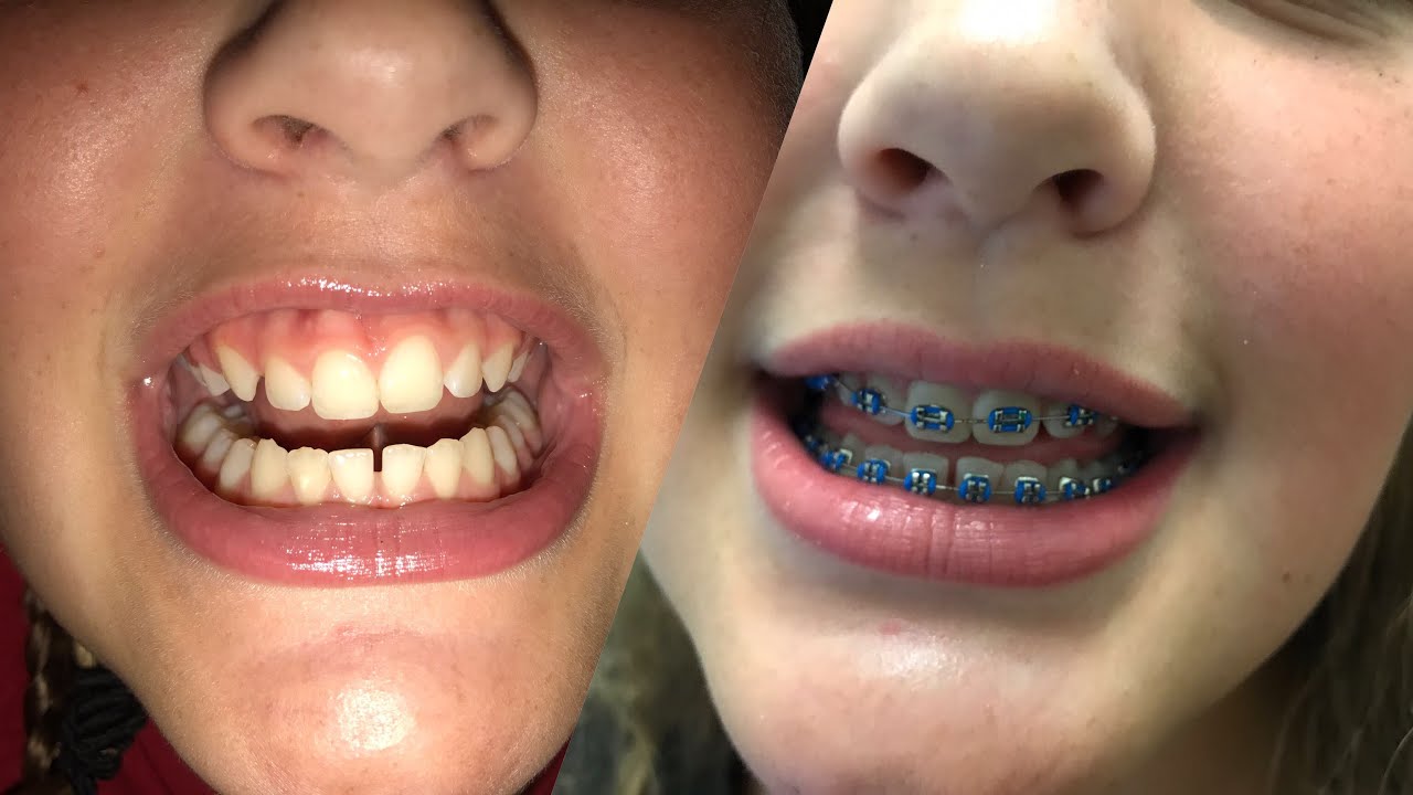 Getting Braces and Palate Expander