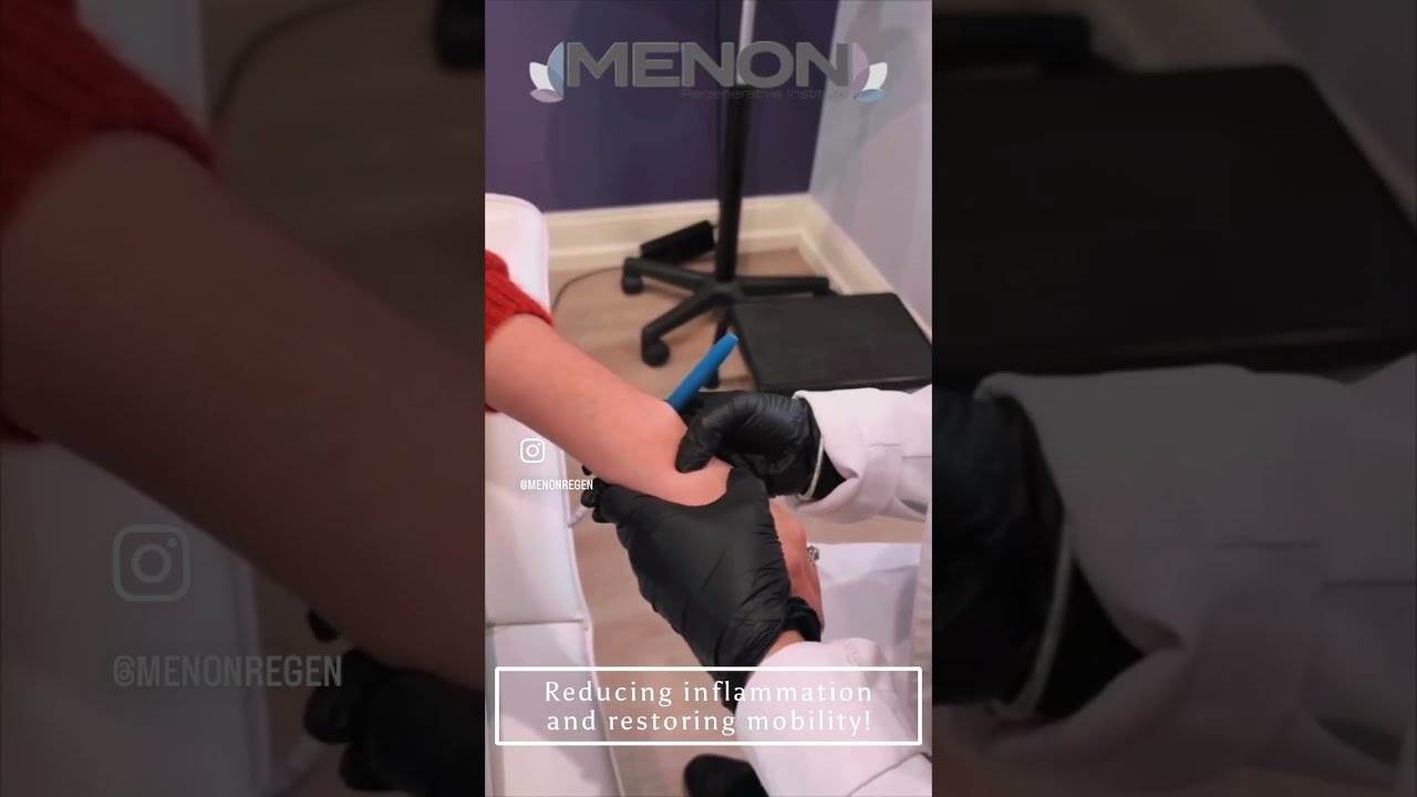 Cortisone Shot for Wrist Pain Relief | See How It Works! 