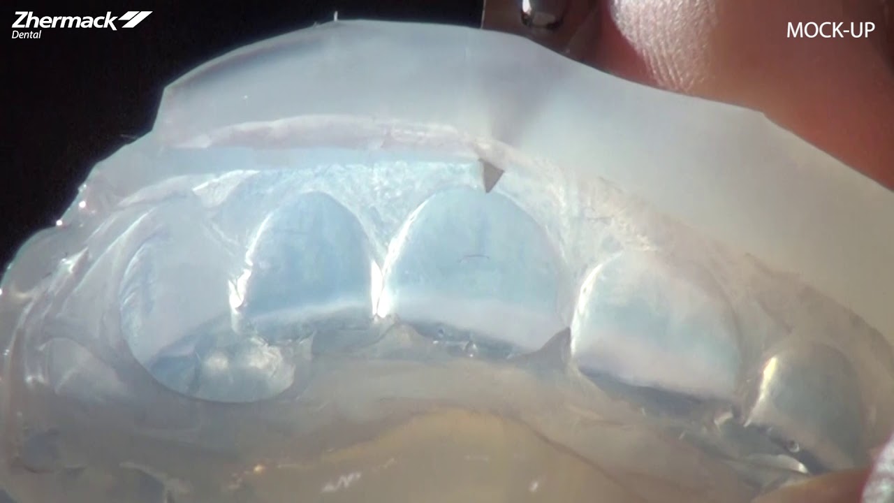 Veneers Procedure Overview Mockup step1