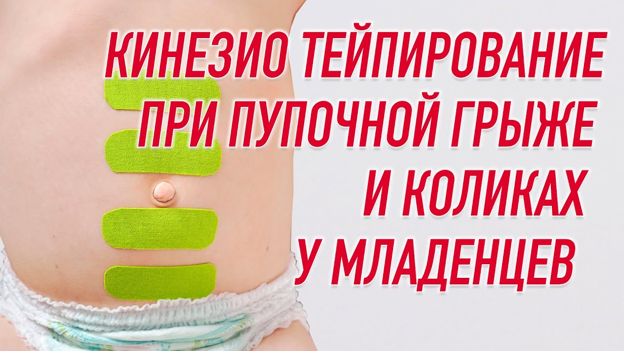 ✅ КИНЕЗИО ТЕЙПИРОВАНИЕ ПРИ ПУПОЧНОЙ ГРЫЖЕ И КОЛИКАХ У МЛАДЕНЦЕВ | Наталья Суворова | BBALANCE