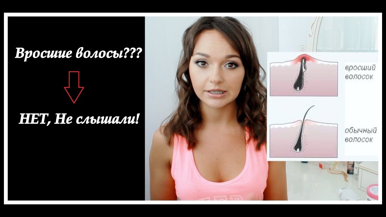 БОРЬБА С ВРОСШИМИ ВОЛОСАМИ. МОЙ ОПЫТ.