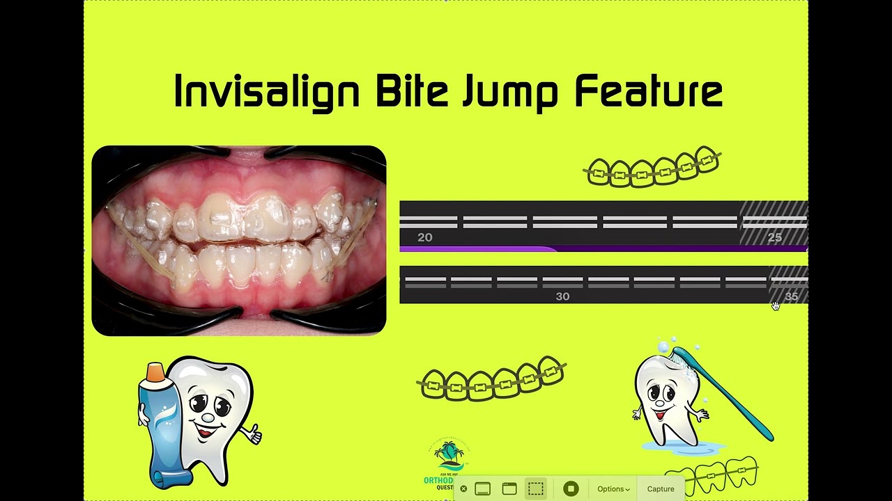 Invisalign Bite Jump Feature