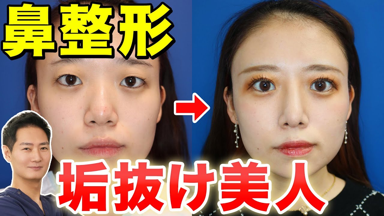【鼻整形】鼻プロテーゼで垢抜け美人に！症例写真もご紹介