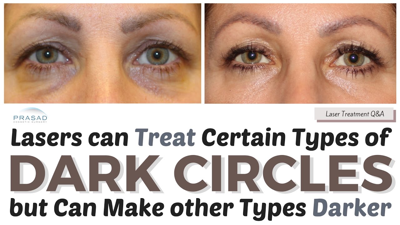 Treating Dark Circles - How Lasers can Treat Some Causes, and Other Treatments to Improve Color