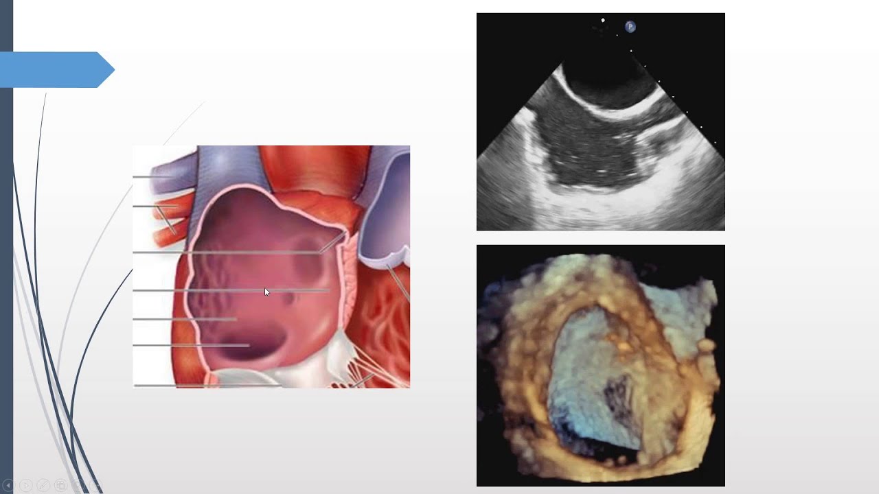 How to image the inter-atrial septum using 3D-TEE 