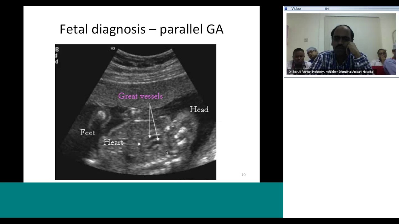 d-TGA diagnosis and preoperative assessment by Dr Sivakumar