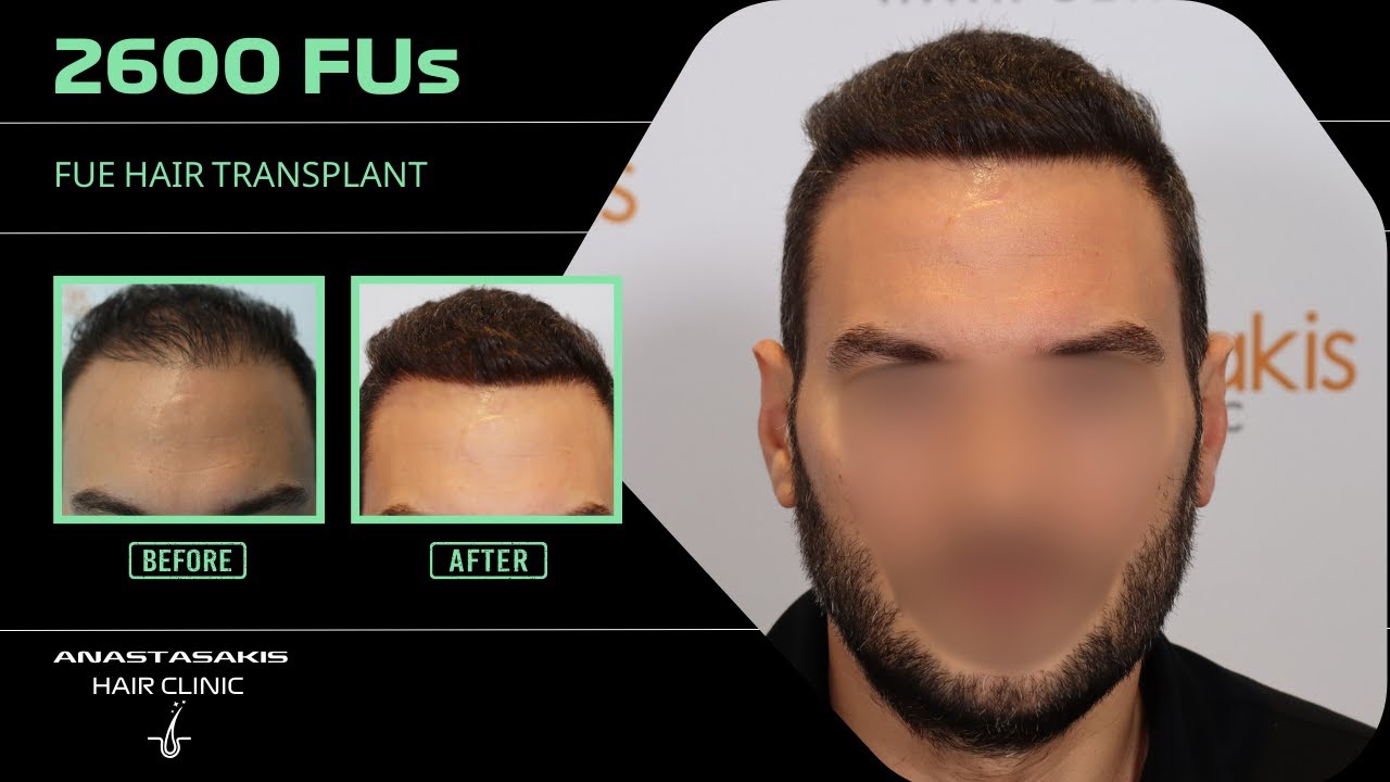 🔥 4 αποτυχημένες μεταμοσχεύσεις… και όμως! 12 μήνες μετά τα 2600 τθ FUE ✨ case #423a