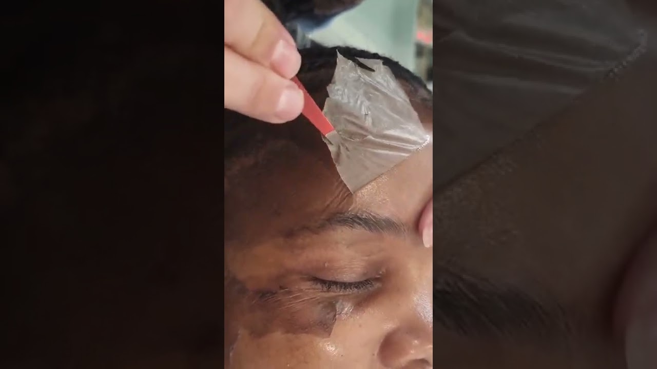 Medical advance Chemical peel,Removing dead skin,healthy healing skin underneath #pigmentation