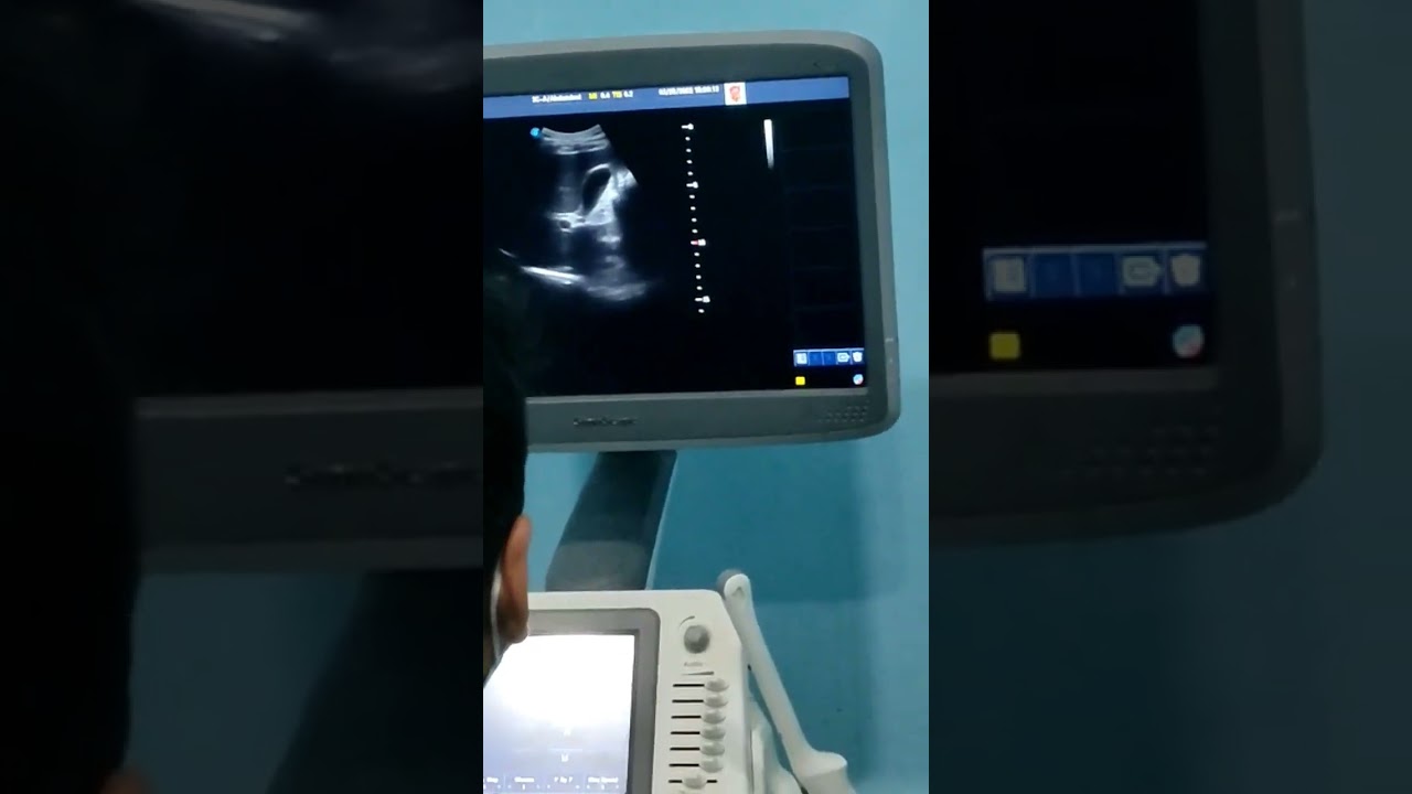 USG of abdomen #ultrasound #sonography #medicalstudent #care #james01