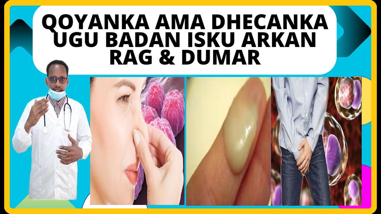 CUDURKA UGU BADAN GALMADA LAGU KALA QAADO  WAXA SABABA CALMADAHISA DAAWEYNTISA DR, MAHAMED LIBAAN