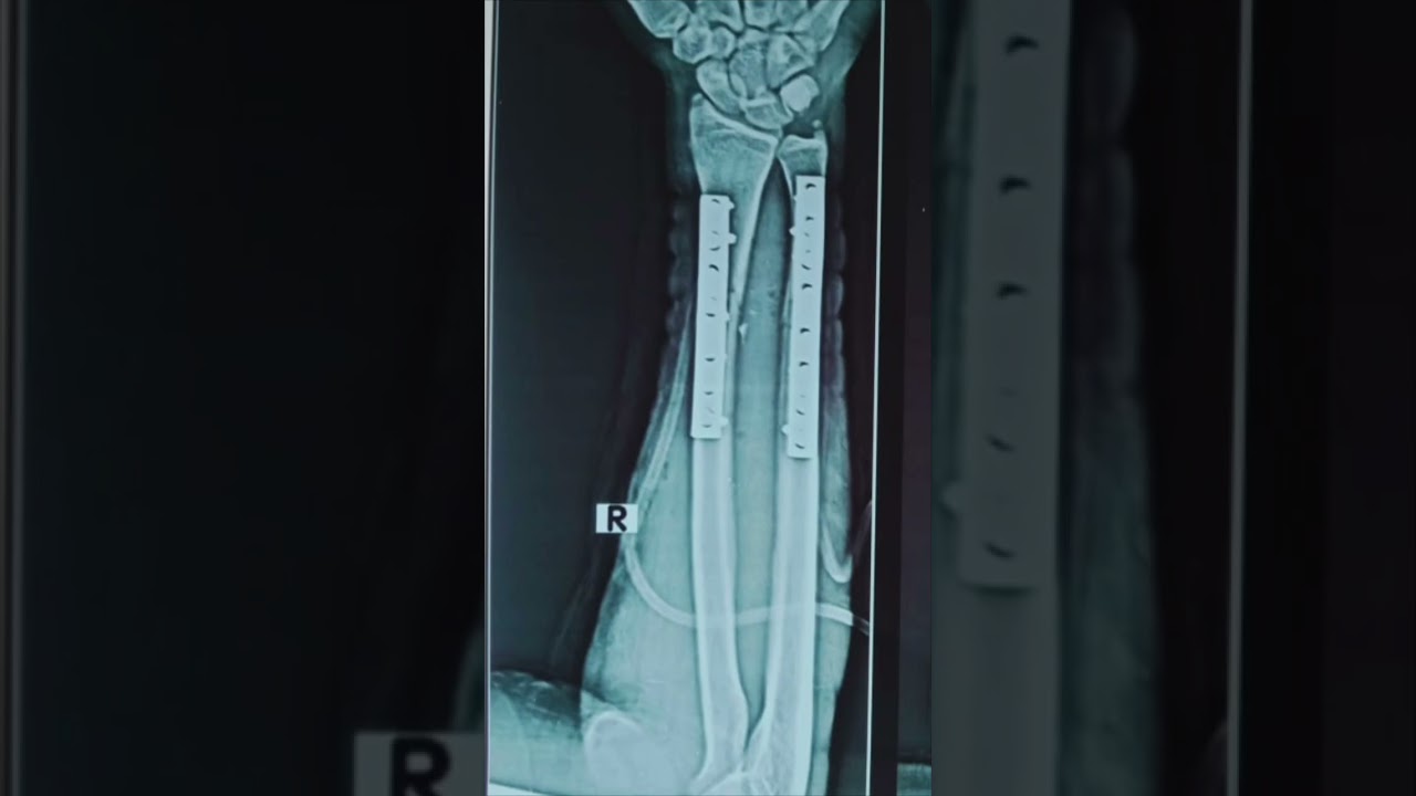 Dynamic compression plate (DCP) for Radius & Ulna Fracture #radius #ulna #fracture #plate #ortho