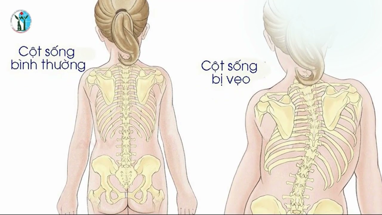 CONG VẸO CỘT SỐNG Ở LỨA TUỔI HỌC ĐƯỜNG