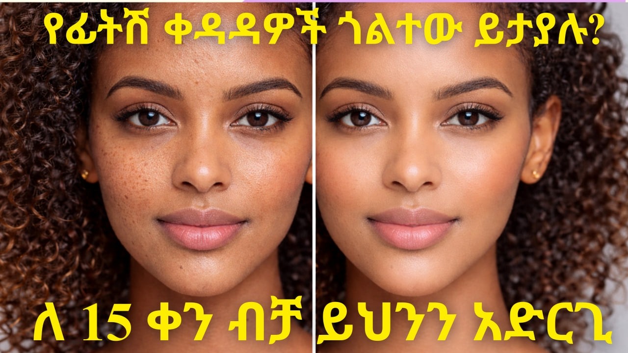 ጠቃጠቆ የፊት ቆዳ ካለሽ ይህንን አድርጊ Natural Home Remedies for Open Pores