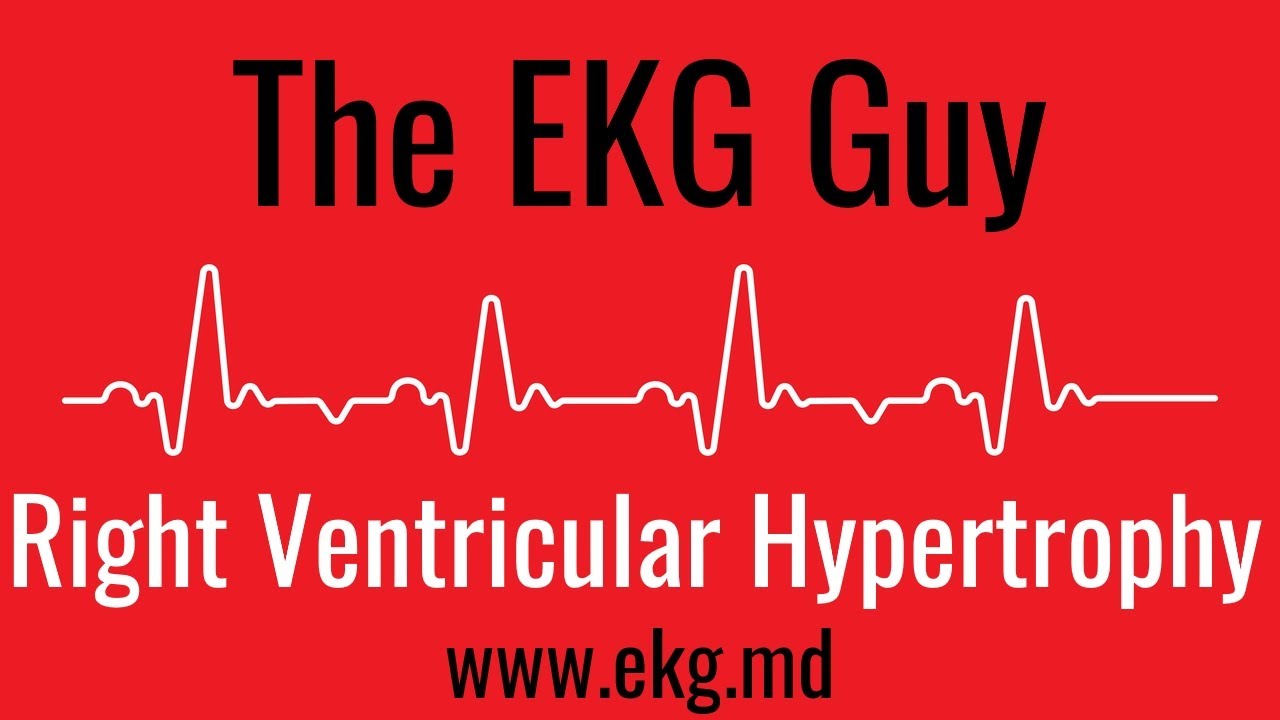 Right Ventricular Hypertrophy on EKG / ECG l The EKG Guy - www.ekg.md