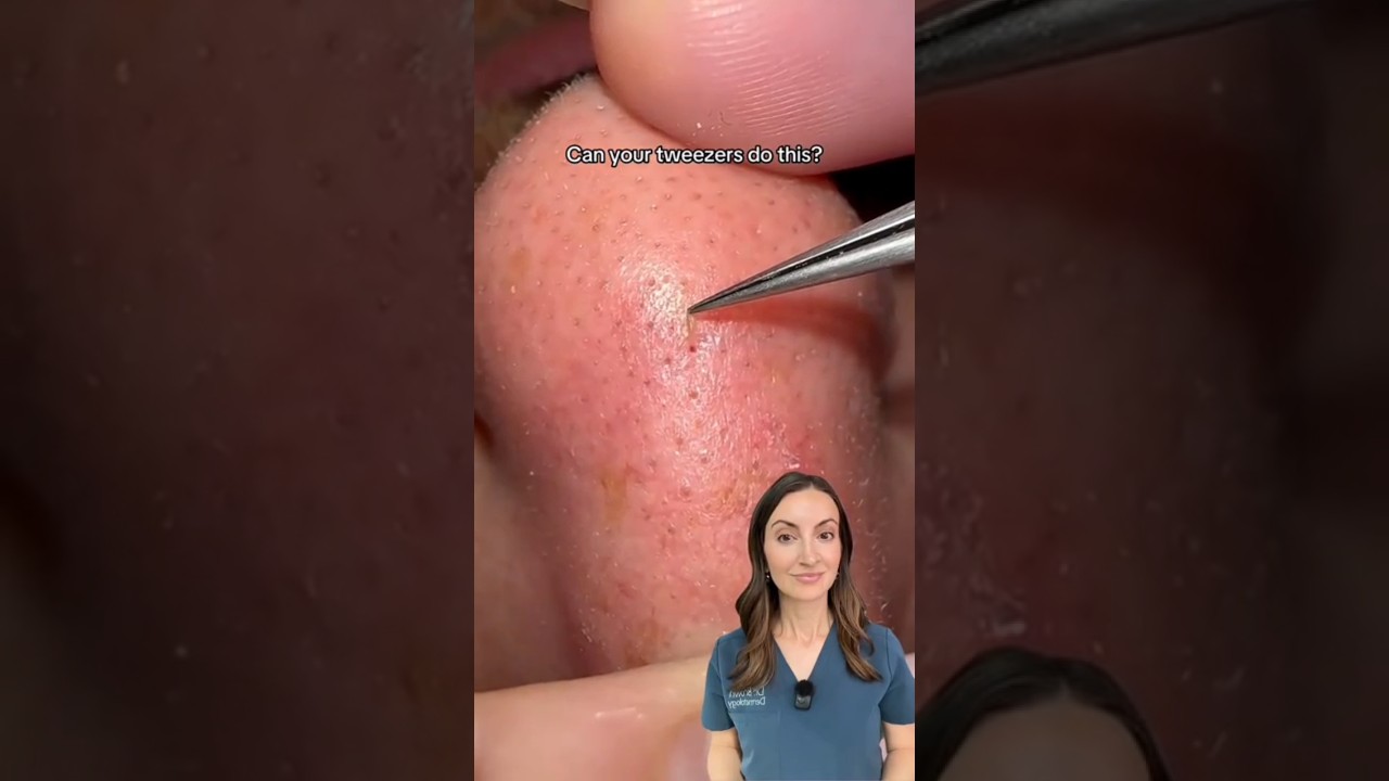 Bigger Pores on the Nose? Let me Help YOU! #sebaceousfilaments #dermtips