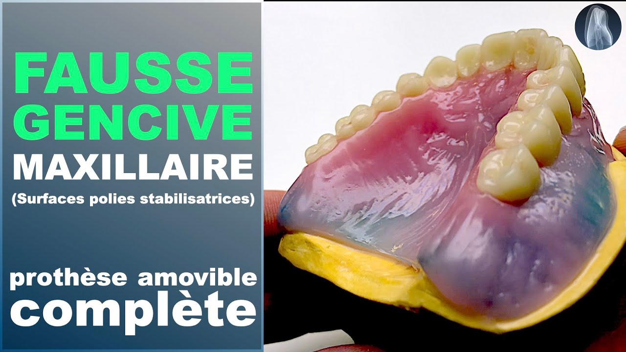 Comment sculpter une fausse gencive et un faux palais parfaits pour vos prothèses amovibles totales