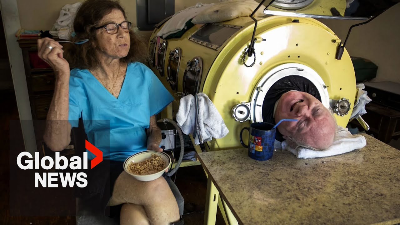 &lsquo;Iron Lung Man&rsquo; dies at 78 after more than 70 years of paralysis from polio