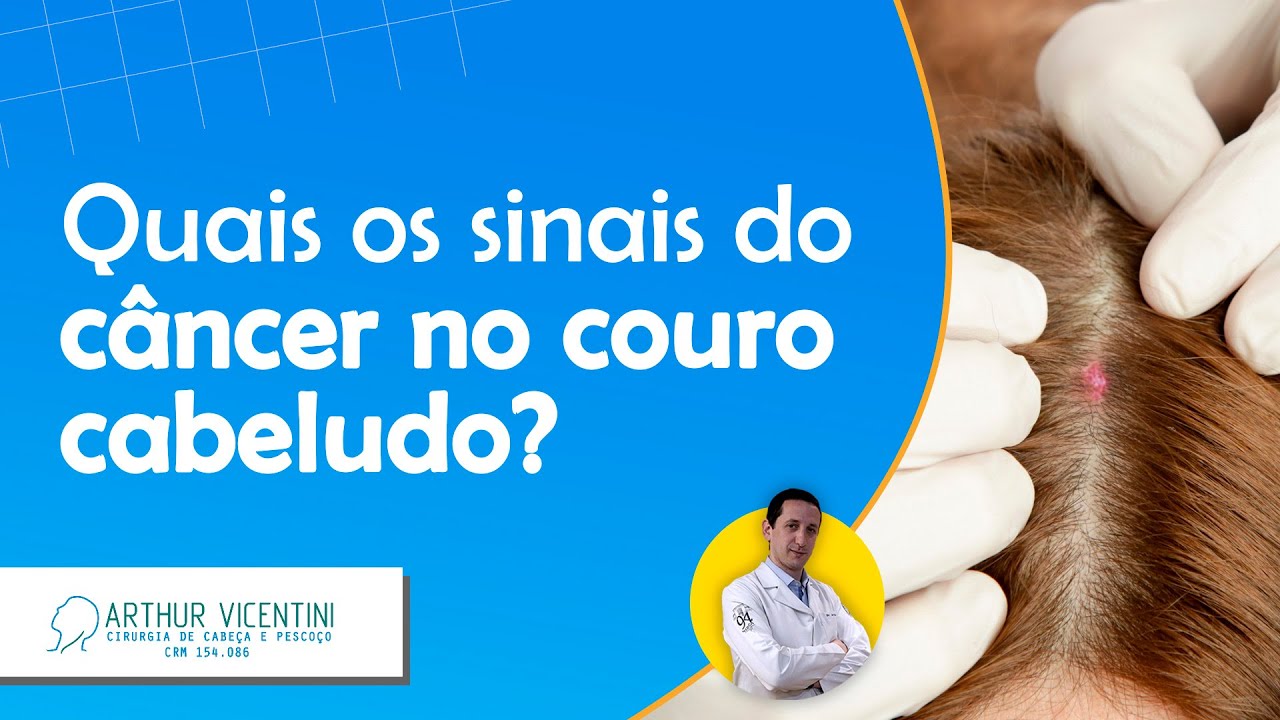 Quais os sinais do câncer no couro cabeludo? | Dr. Arthur Vicentini CRM 154.086