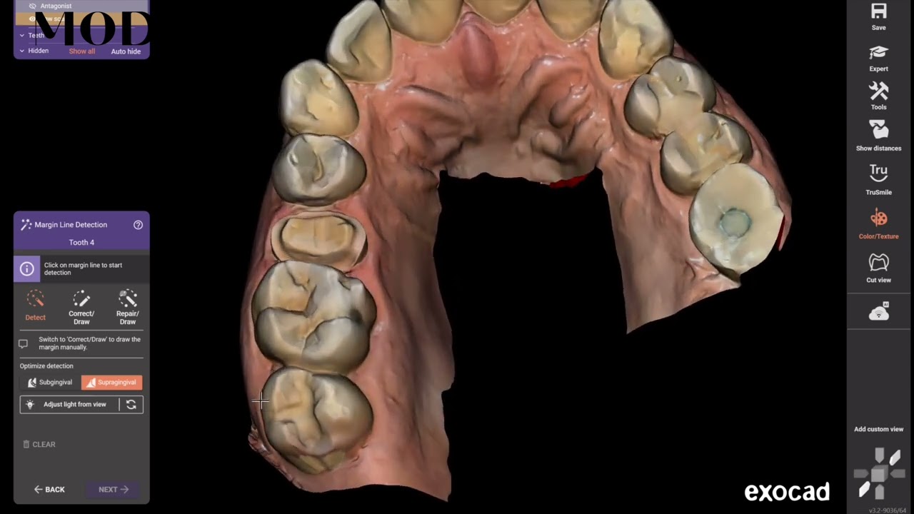 CEREC with  exocad: how to get good fits