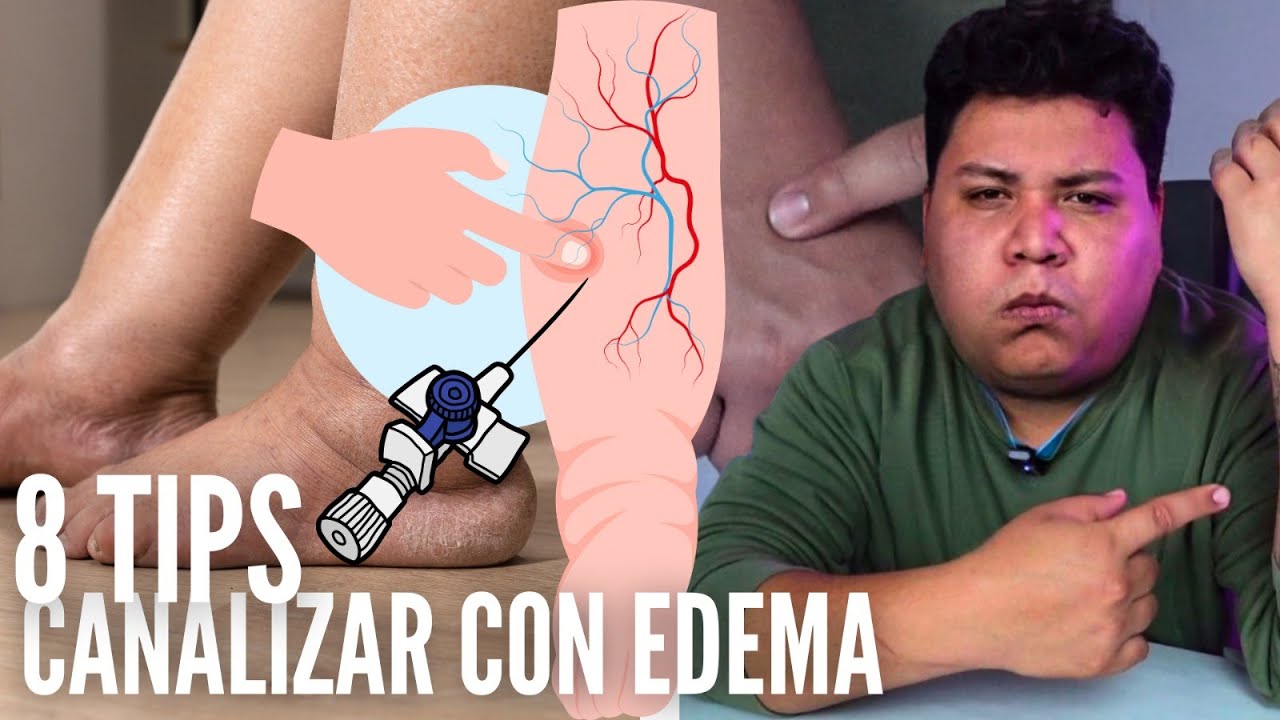 8 TIPS RAPIDOS para ver LAS VENAS EN SEGUNDOS al en PACIENTES con EDEMA 💉| Enfermeria