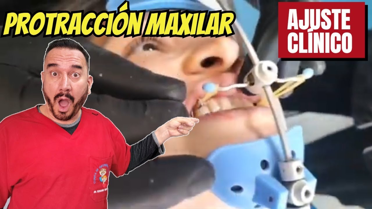 PROTRACCIÓN MAXILAR: Esto es lo que Sucede Después de la Expansión