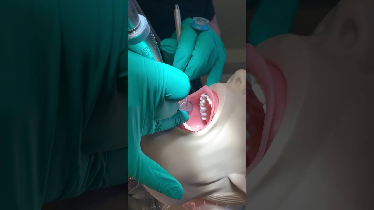 Coronal Polish procedure