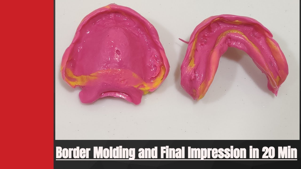 Border Molding / Peripheral Tracing and Final Impression Using Elastomeric impression Material