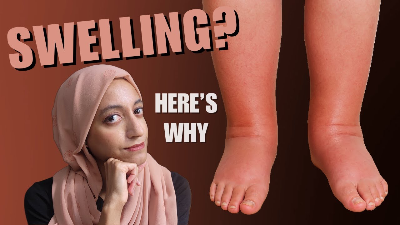 Is Leg Swelling Dangerous or Normal? Depends