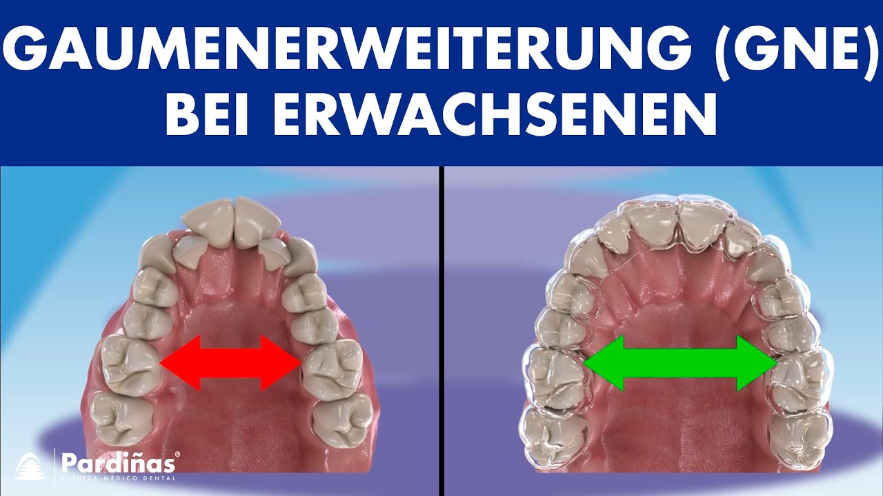 Gaumenerweiterung (GNE) bei Erwachsenen - MARPE Technik ©