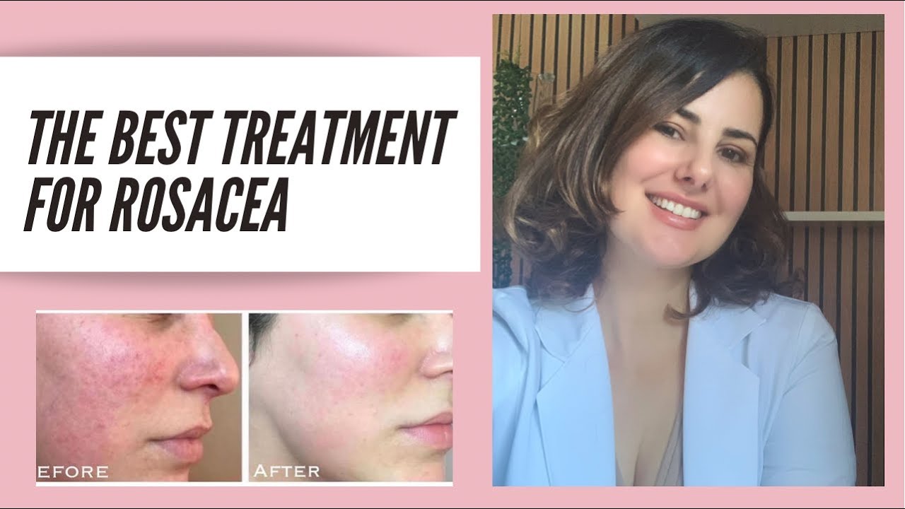 The Best Treatment for Rosacea!