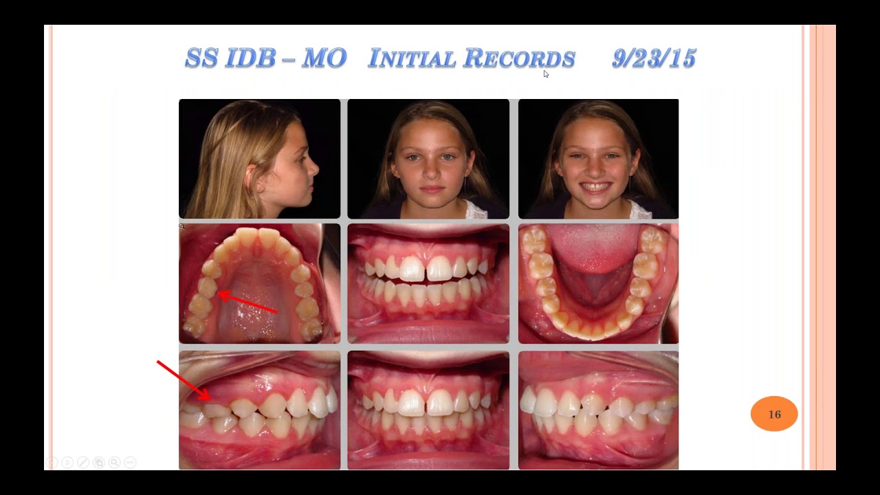 Experience suresmile&reg;, elemetrix&trade; Digital IDB with Dr  Ed Lin