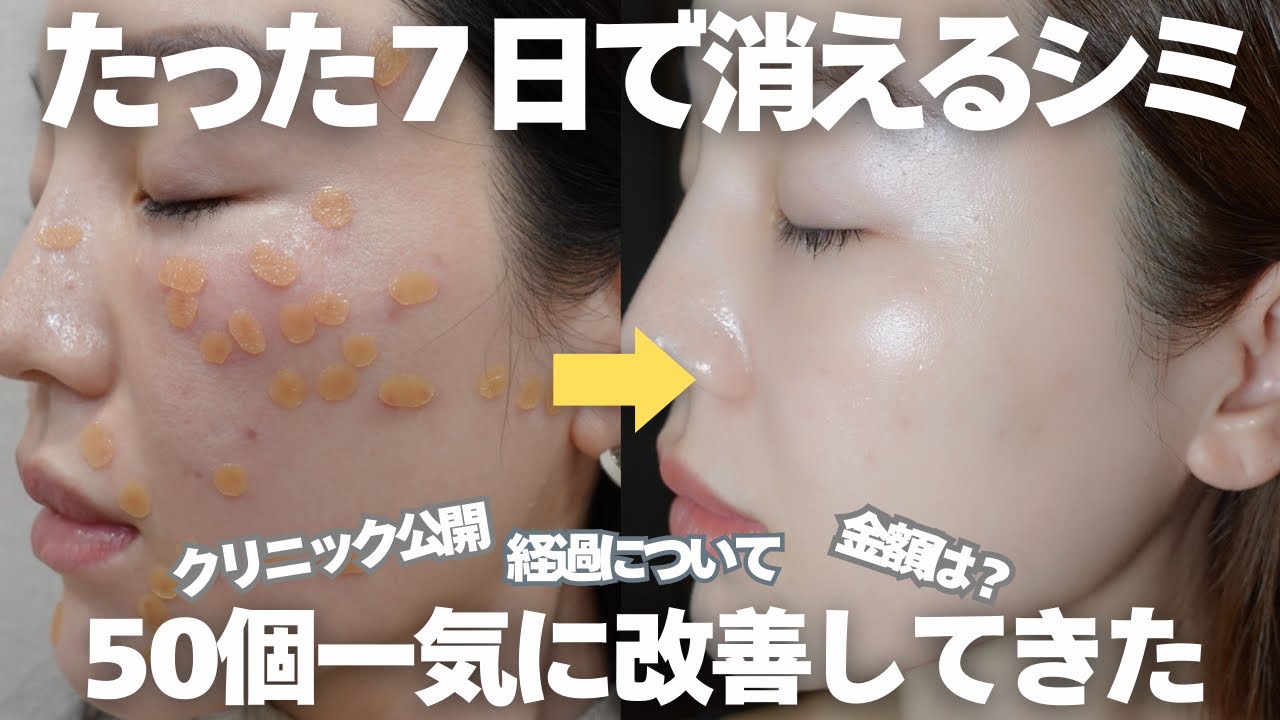 🇯🇵【シミ取り経過】たった7日後の美肌が過去一だった、繰り返すシミ治療を日本クリニックで終止符を‼︎