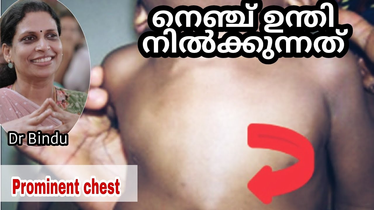 നെഞ്ച് ഉന്തി നിൽക്കുന്നത്/Prominent chest can be a sign of some diseases!!/Dr Bindu 