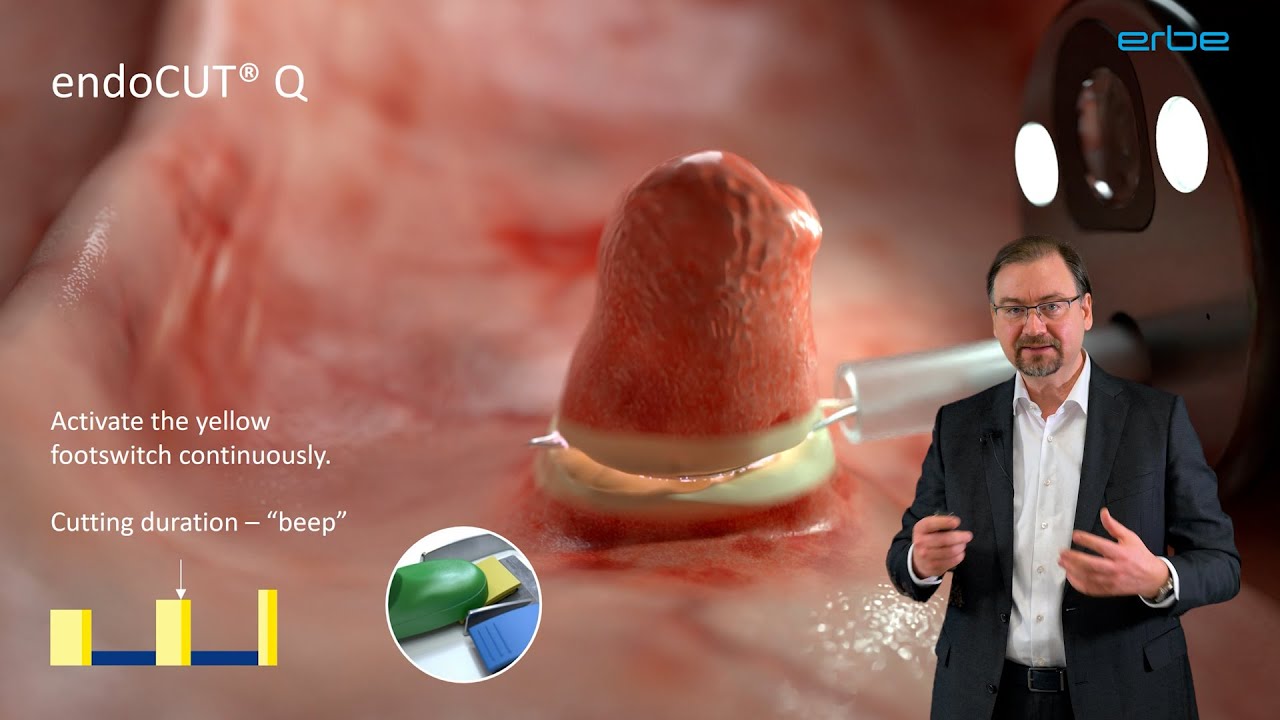 endoCUT&reg; - spark recognition technology in endoscopic procedures / webcast