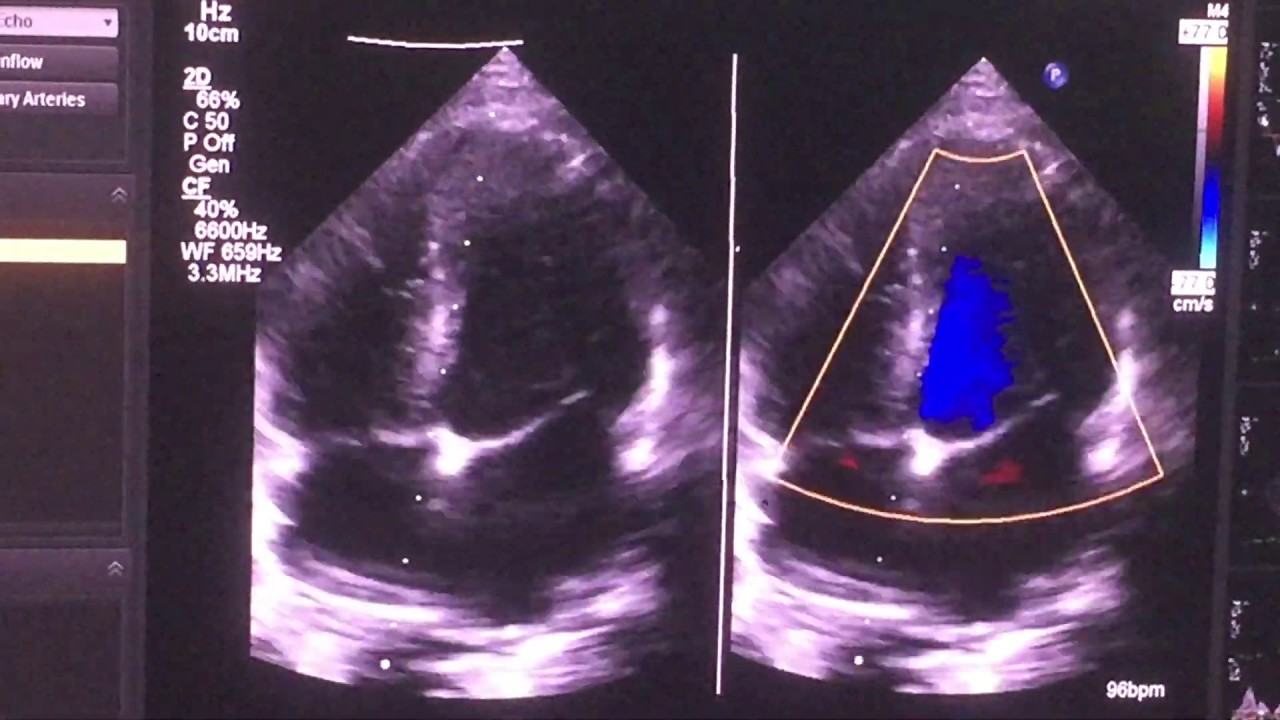 Outlet ventricular septal defect