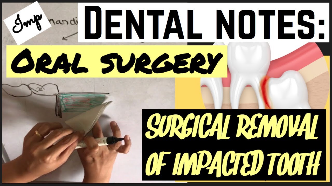 SURGICAL REMOVAL OF IMPACTED TOOTH || TECHNIQUE || ORAL SUREGERY || IMPACTION (imp)