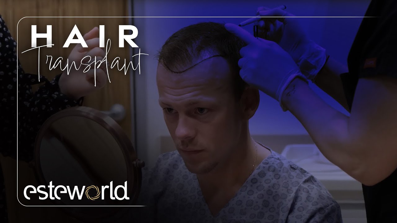 Hair Transplant | Robin Van Weerle  | Your Story