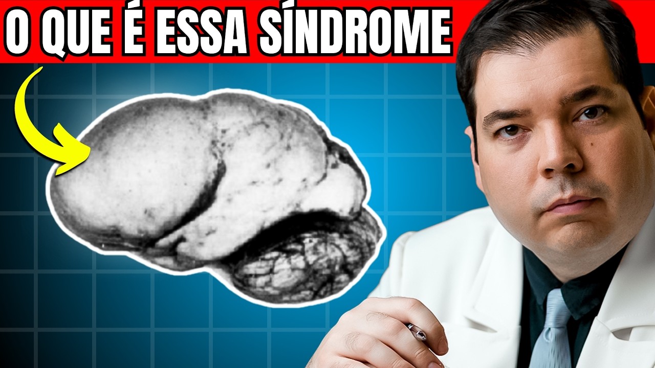 Síndrome de Miller-Diecker: Lisencefalia e Paquigiria