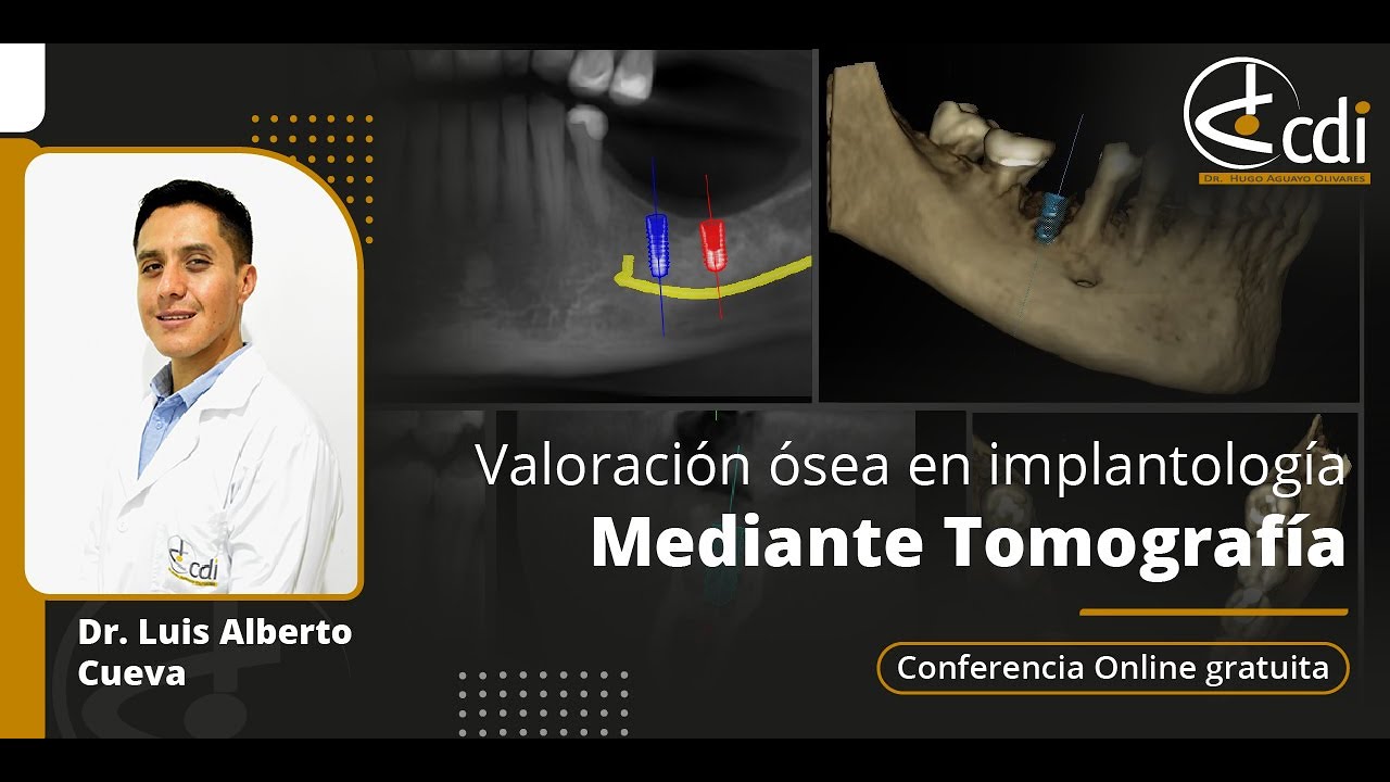 Conferencia Online Valoración Ósea en Implantología Mediante Tomografía