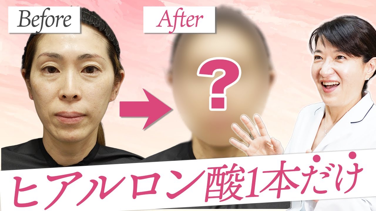 ヒアルロン酸1本で自然な変化を。周りにバレずに変わるおすすめの部位を皮膚科専門医が全て解説します【千春皮フ科クリニック/浦和】