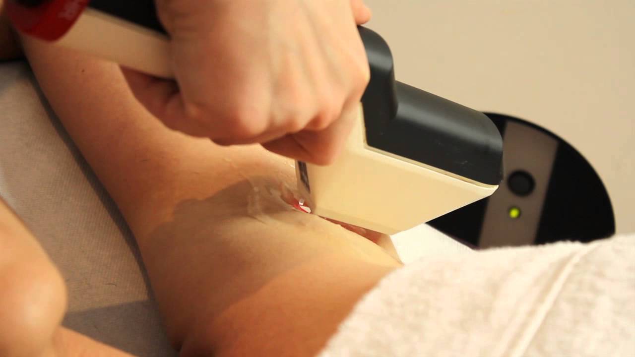 Depilacja IPL