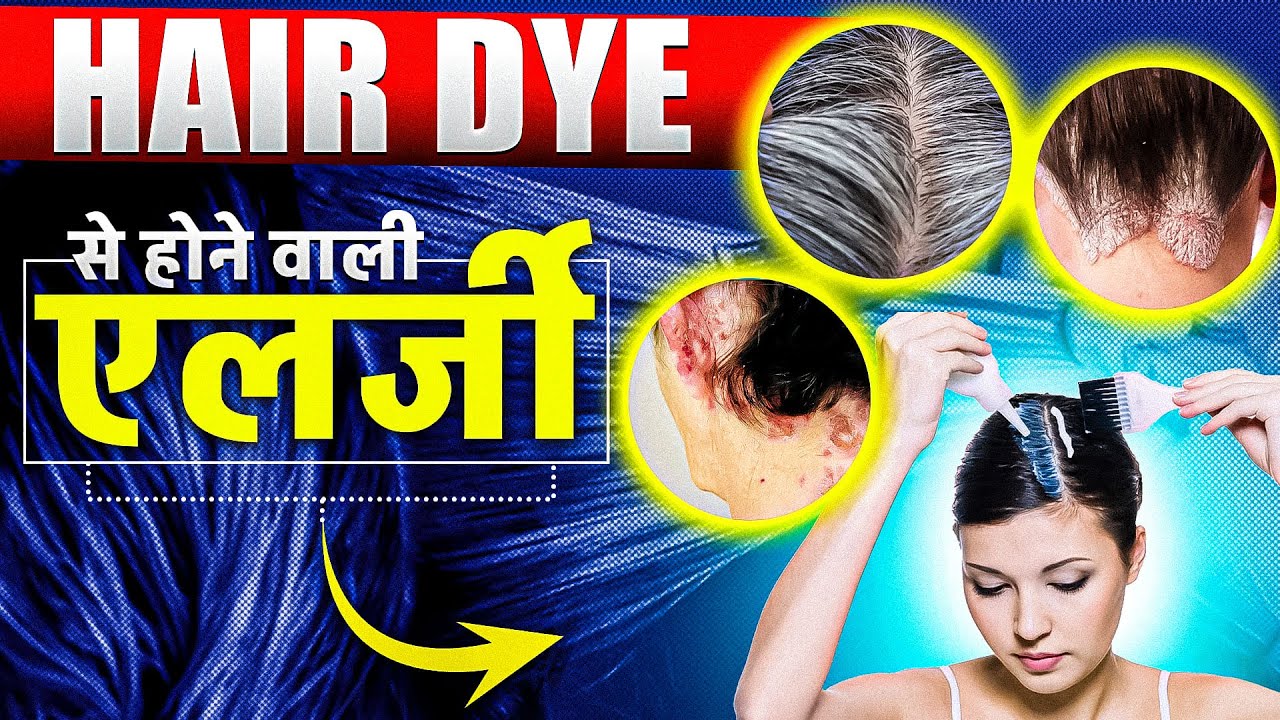हेयर डाई से होने वाली एलर्जी Hair Dye Allergy Symptoms and Treatment in Hindi| Dr Geetika Srivastava