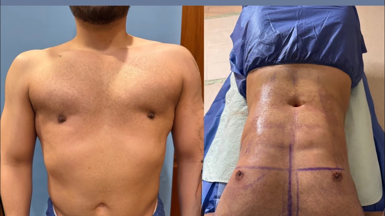 LEBO GYNO & BEYOND 29 TEXAS MALE BEFORE & AFTER IMMEDIATE RESULTS