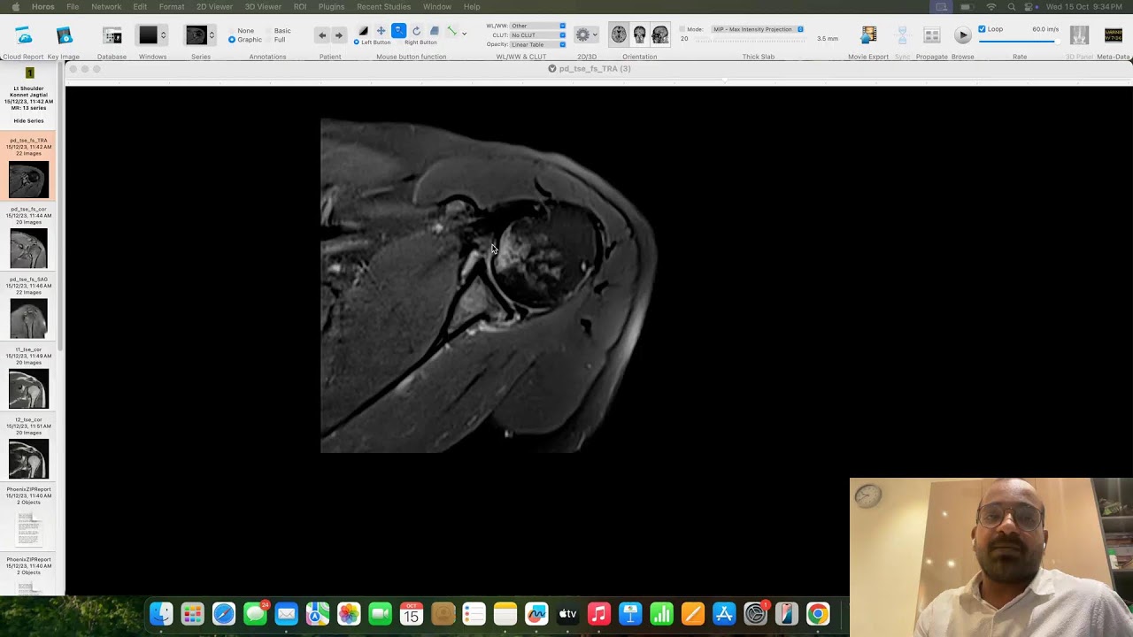 MSK CASE DISCUSSION 2*