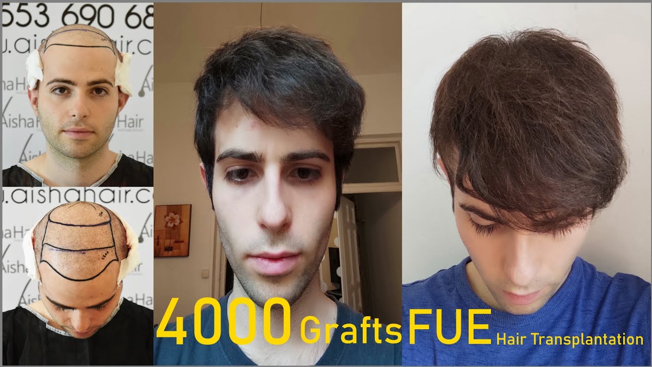 FUE Hair Transplantation Growth / Crecimiento del Pelo Después de un Injerto Capilar FUE