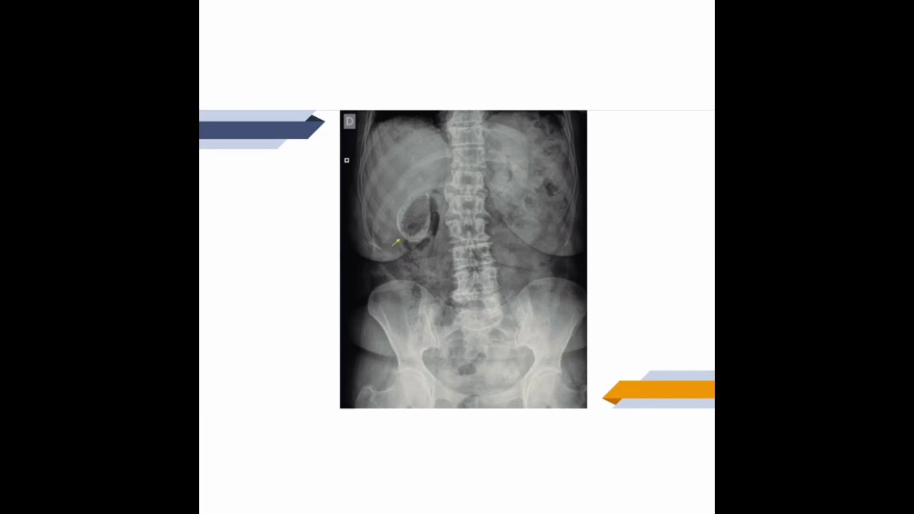 Calcificación abdominal