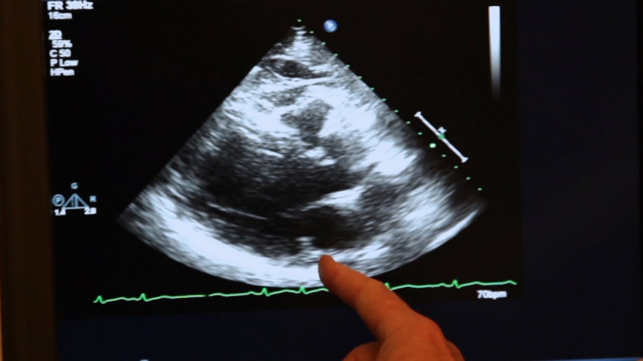 Echocardiogram Demonstration