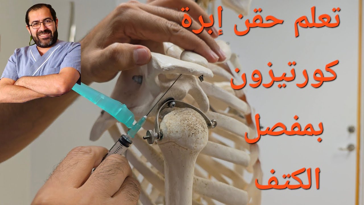 حقن كورتيزون في مفصل الكتف + ما تحتاج معرفته عن الكتف المتجمد