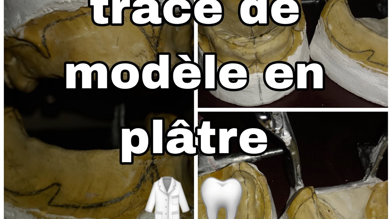 tracé le modèle en plâtre de P.A.T  [vidéo 1] pour faire un montage#dental #dentist #maroc