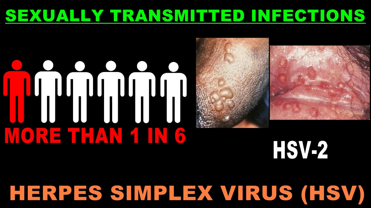 Sexually Transmitted Diseases